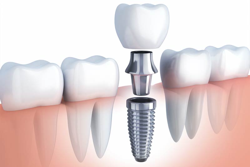 Dental Implants in Hurst