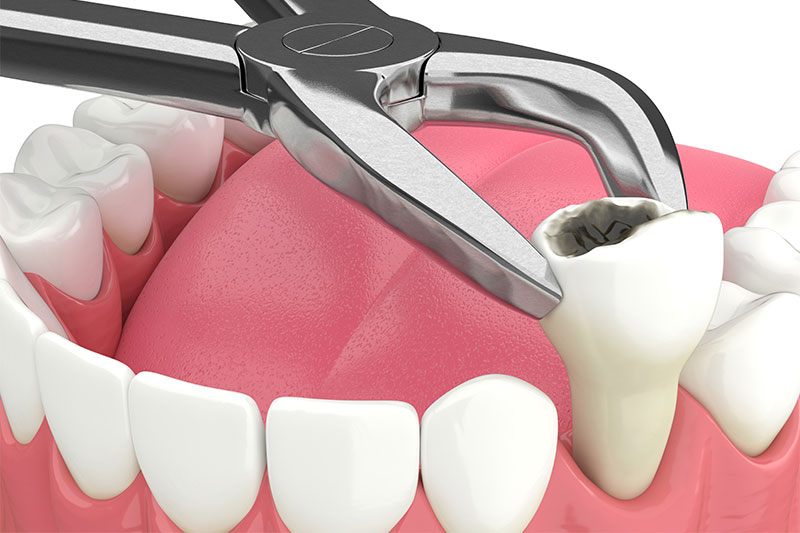 Tooth Extractions in Hurst